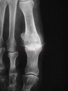 Hallux rigidus : l'usure articulaire se manifeste sur la radiographie de face par un pincement de l'articulation