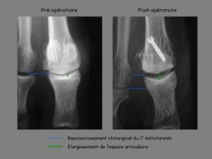 Hallux rigidus : l'usure articulaire se manifeste sur la radiographie de face par un pincement de l'articulation