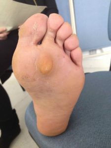 Hallux valgus : une déformation importante peut retentir sur les rayons latéraux. Ici, le 2ème métatarsien reçoit un excès de charge comme en témoigne ce durillon