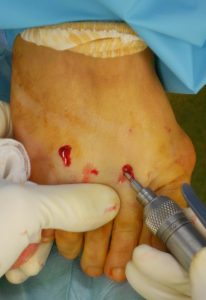 Percutaneous surgery : percutaneous osteotomies of lateral metatarsal necks