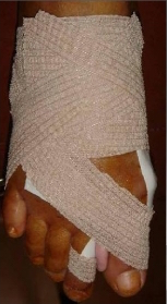 Percutaneous surgery : the postoperative bandage and a silicone wedge maintain the corrections when no screw is implanted