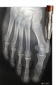 Fraisage de l'exostose en chirurgie percutanée de l'hallux valgus
