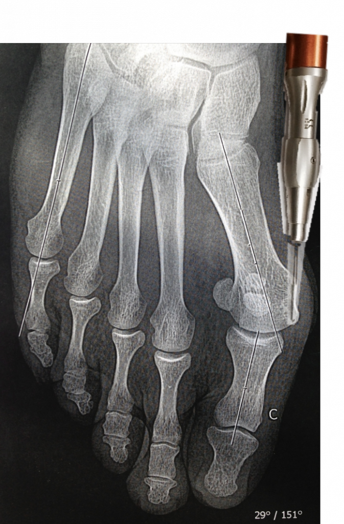 Chirurgie percutanée Chirurgie du Pied Chirurgie percutanée Chirurgie du Pied