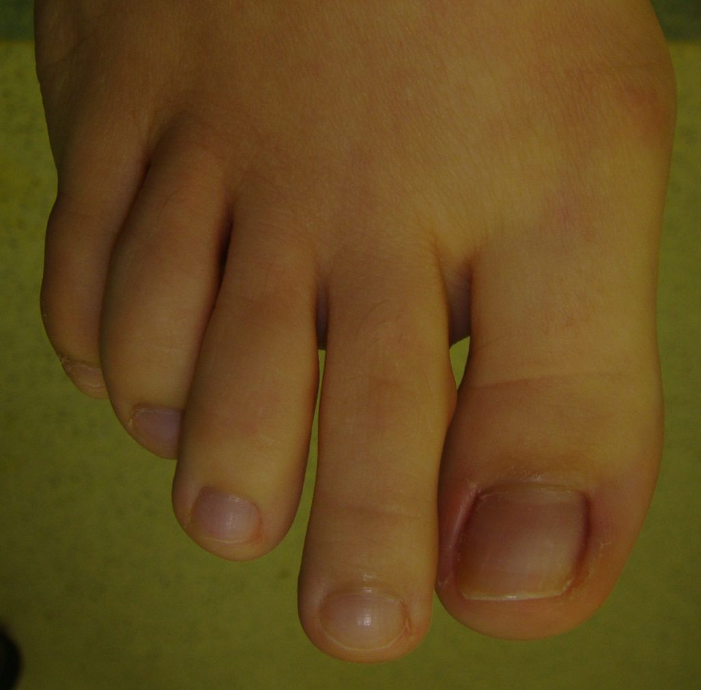 Orteils en griffe Chirurgie du Pied