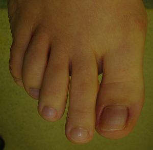 Greek forefoot: the second toe is longer than all the others. It comes butting up against the shoe tip.