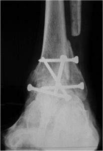 Total ankle arthroplasty: arthrodesis is the main alternative to it. The fusion of tibia and talus blocks the ankle motion