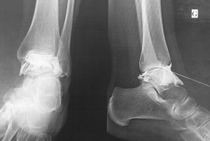 Total ankle arthroplasty: a steroid joint injection under radiographic control is a treatment option to postpone surgery