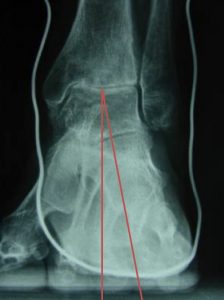 Mesure de l'axe de l'arrière pied par des clichés radiographiques dits de "Méary"