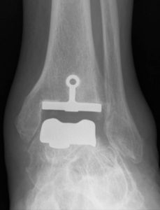 Radiographie postopératoire d'une prothèse de cheville en place