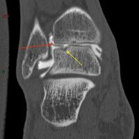 LODA : l'arthroscanner met en évidence des fragments cartilagineux (flèches rouges) et une atteinte de l'os sous-chondral (flèches jaunes)