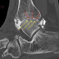 Ostéochondrite : l'arthroscanner met en évidence des fragments cartilagineux (flèches rouges) et une atteinte de l'os sous-chondral (flèches jaunes)