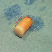 LODA - Mosaicplasty : une carotte de cartilage (zone jaune) et d'os sous-chondral (zone rouge) est prélevée au genou