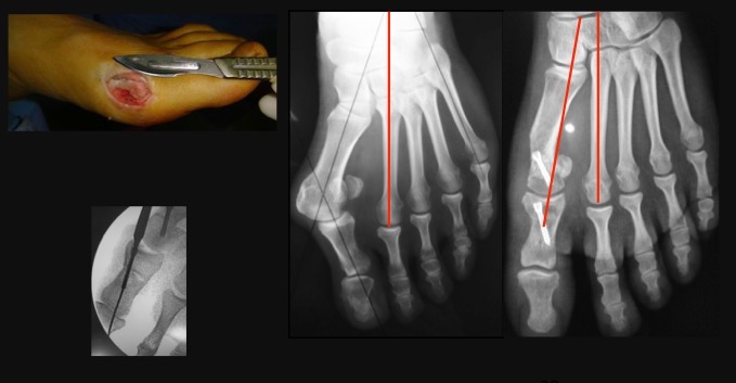 Chirurgie mini-invasive permettant la même correction qu'à ciel ouvert