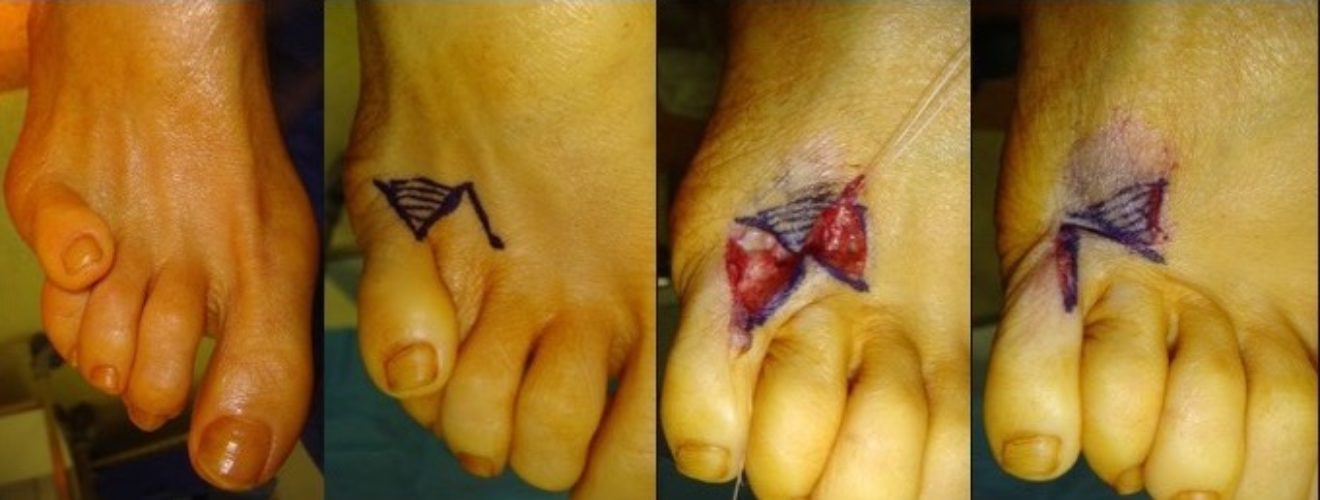 Quintus varus Chirurgie du Pied