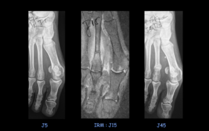 Fracture de fatigue du deuxième métatarsien