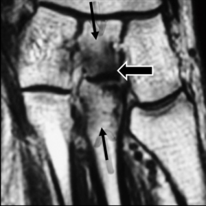 Fracture de contrainte du deuxième cunéiforme