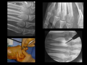 Distal metatarsal mini-invasive osteotomy ; ostéotomie de recul et d’ascension des métatarsiens latéraux