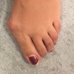 Hallux valgus : déformation du gros orteil, dévié vers les autres orteils
