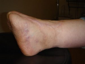 Amputation d'un pied diabétique