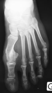 Hallux valgus opéré d'un pied diabétique sans fixation osseuse